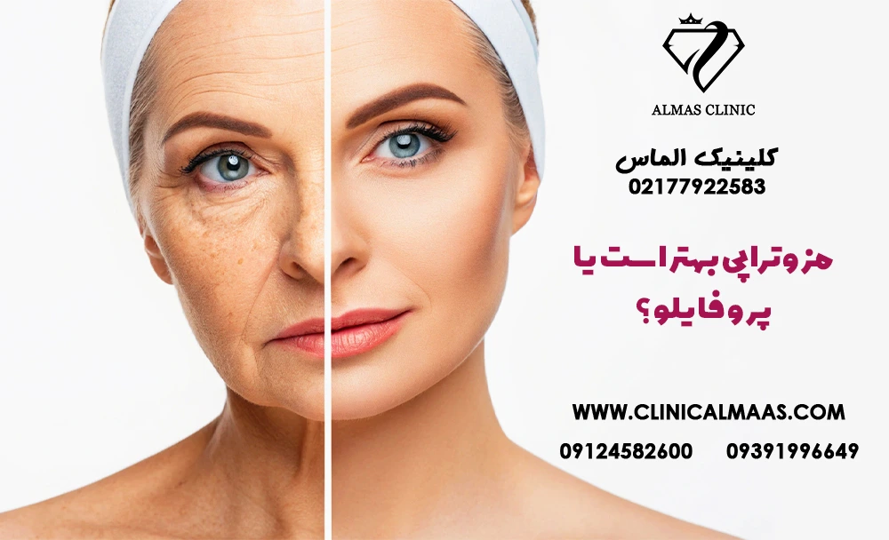 مزوتراپی بهتر است یا پروفایلو؟